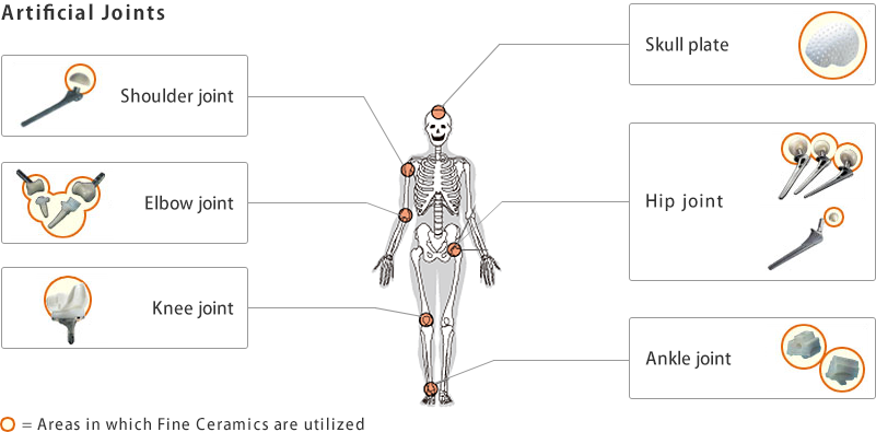 figure:Artificial joints