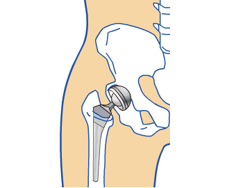 Problems with Artificial Hip Joints